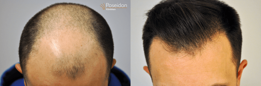 hårtransplantation før og efter