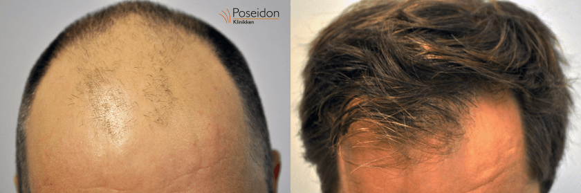 hårtransplantation før og efter