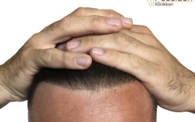 En hårtransplantation for et ungt menneske er ikke nødvendigvis det rigtige valg.